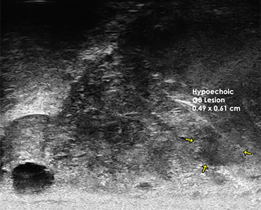 Detection and targeting of small Gleason 8 Lesion