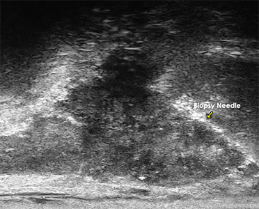 Detection and targeting of small Gleason 8 Lesion