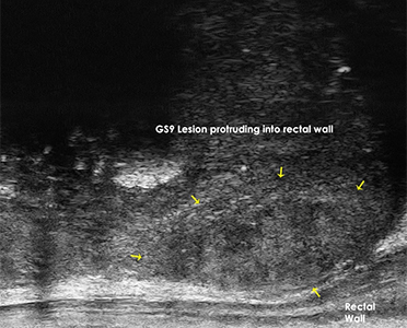 Gleason 9 Lesion Visualized Protruding into the Rectal Wall