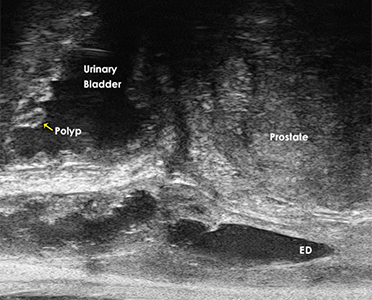 Visualization of Ejaculatory Duct, Polyp and Urinary Bladder