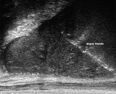 Visualization of Prostate Biopsy Needle Track Filling with Blood