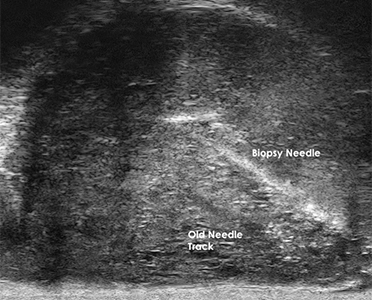 Visualization of Old and New Biopsy Needle Track