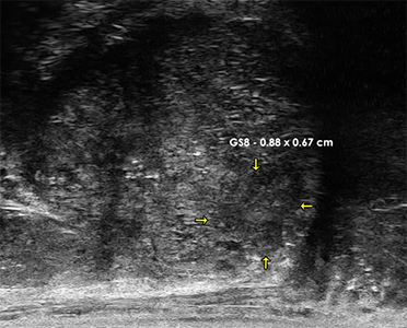Detection and targeting of small Gleason 8 Lesion