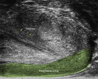 Midline View of the Prostate