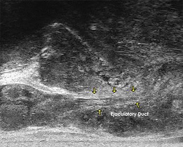 Fluid flowing through Ejaculatory Duct